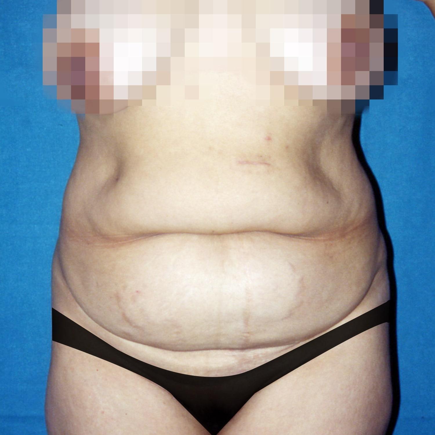 Abdominoplastia