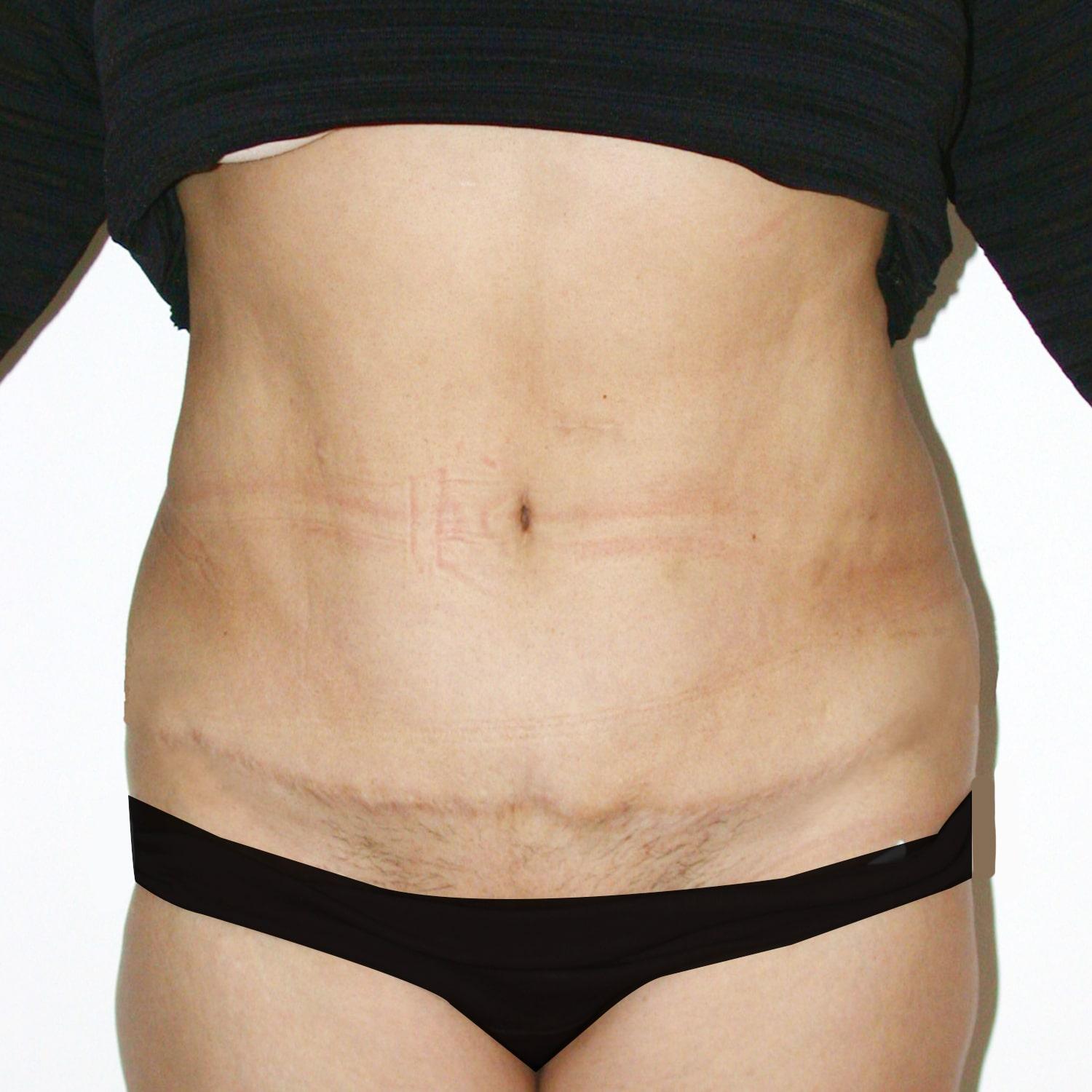 Abdominoplastia
