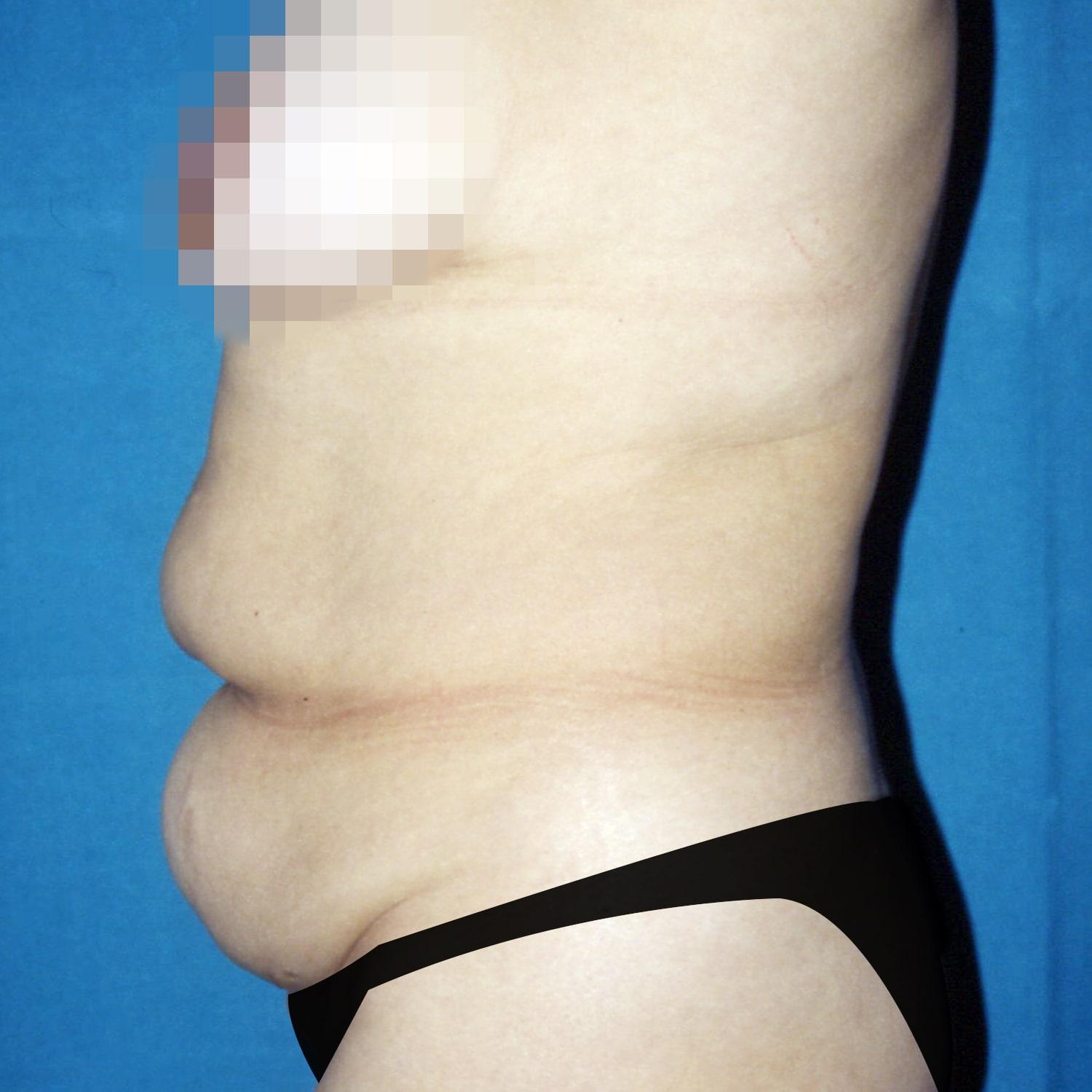 Abdominoplastia