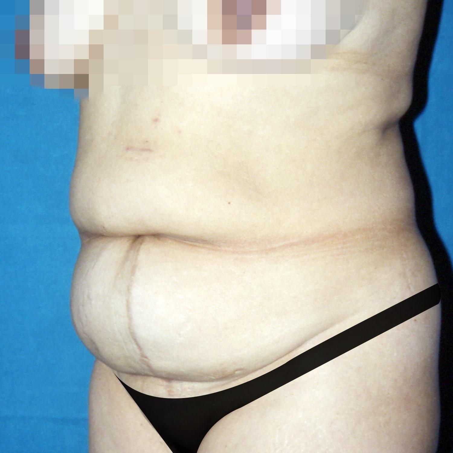 Abdominoplastia