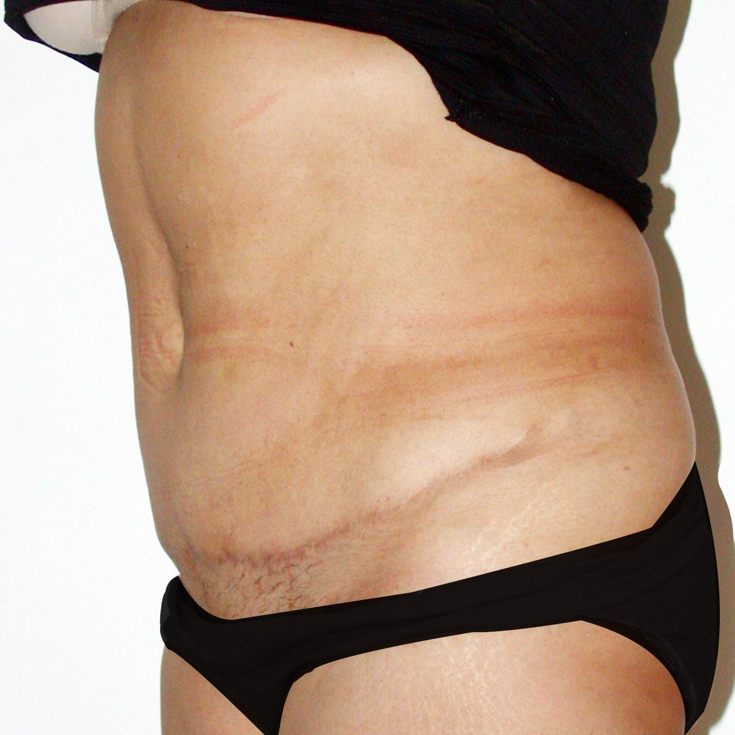 Abdominoplastia