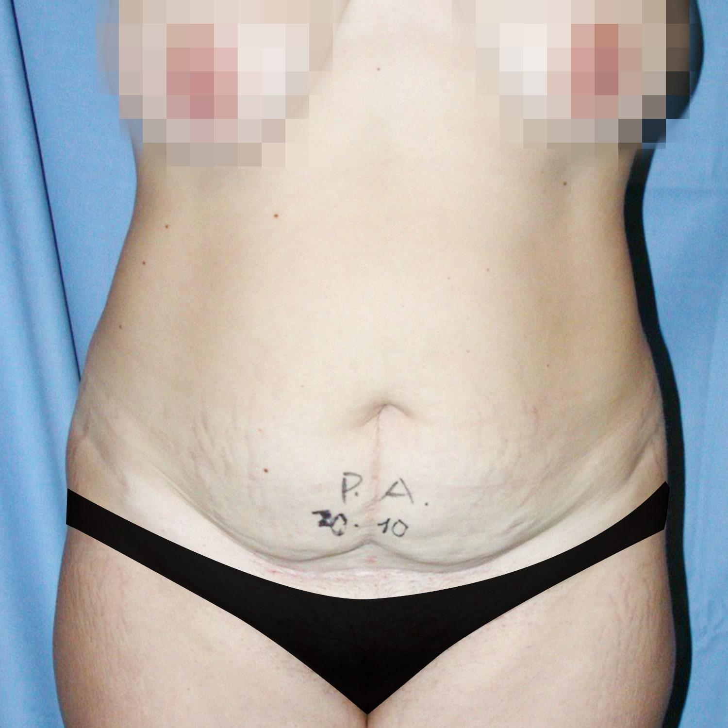 Abdominoplastia