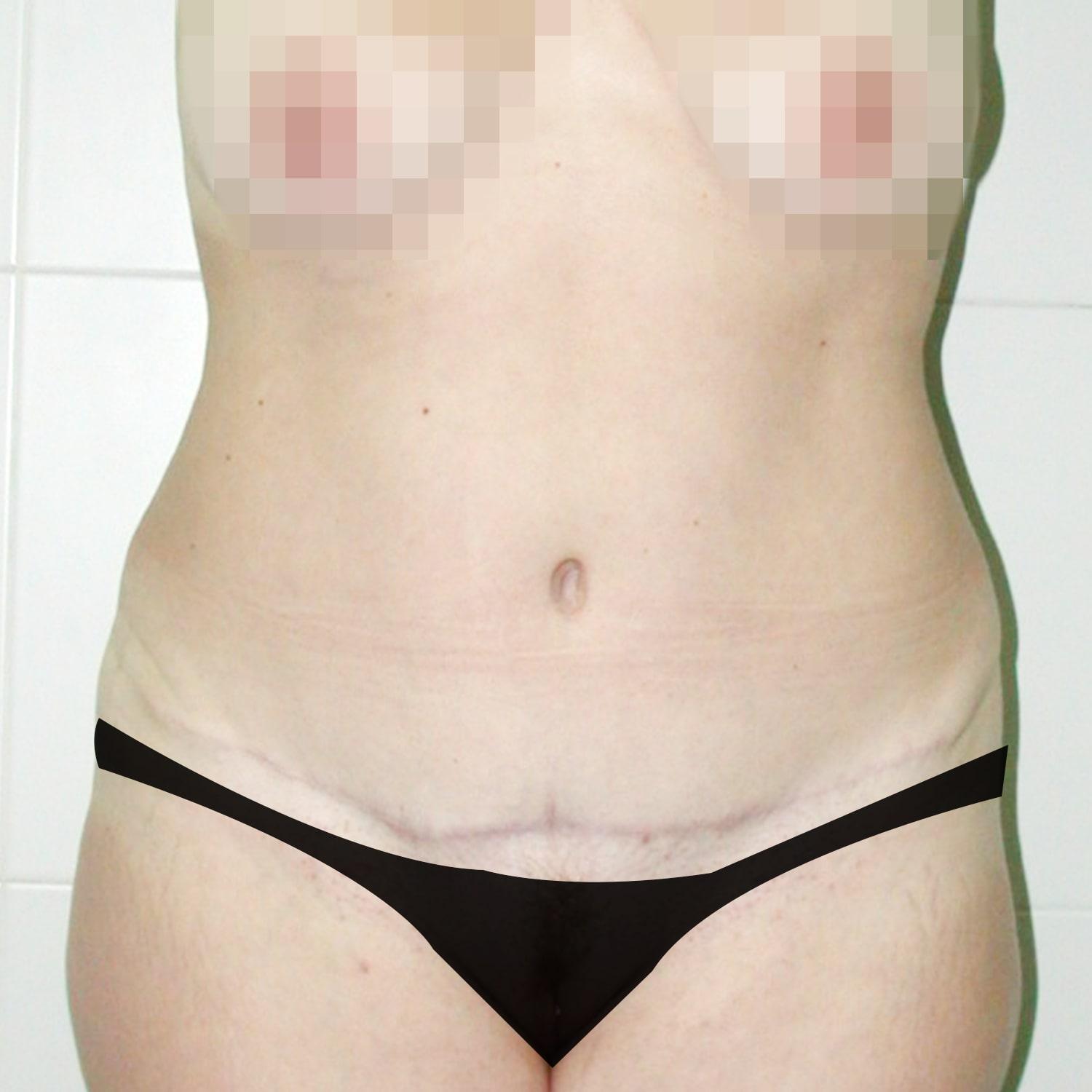 Abdominoplastia