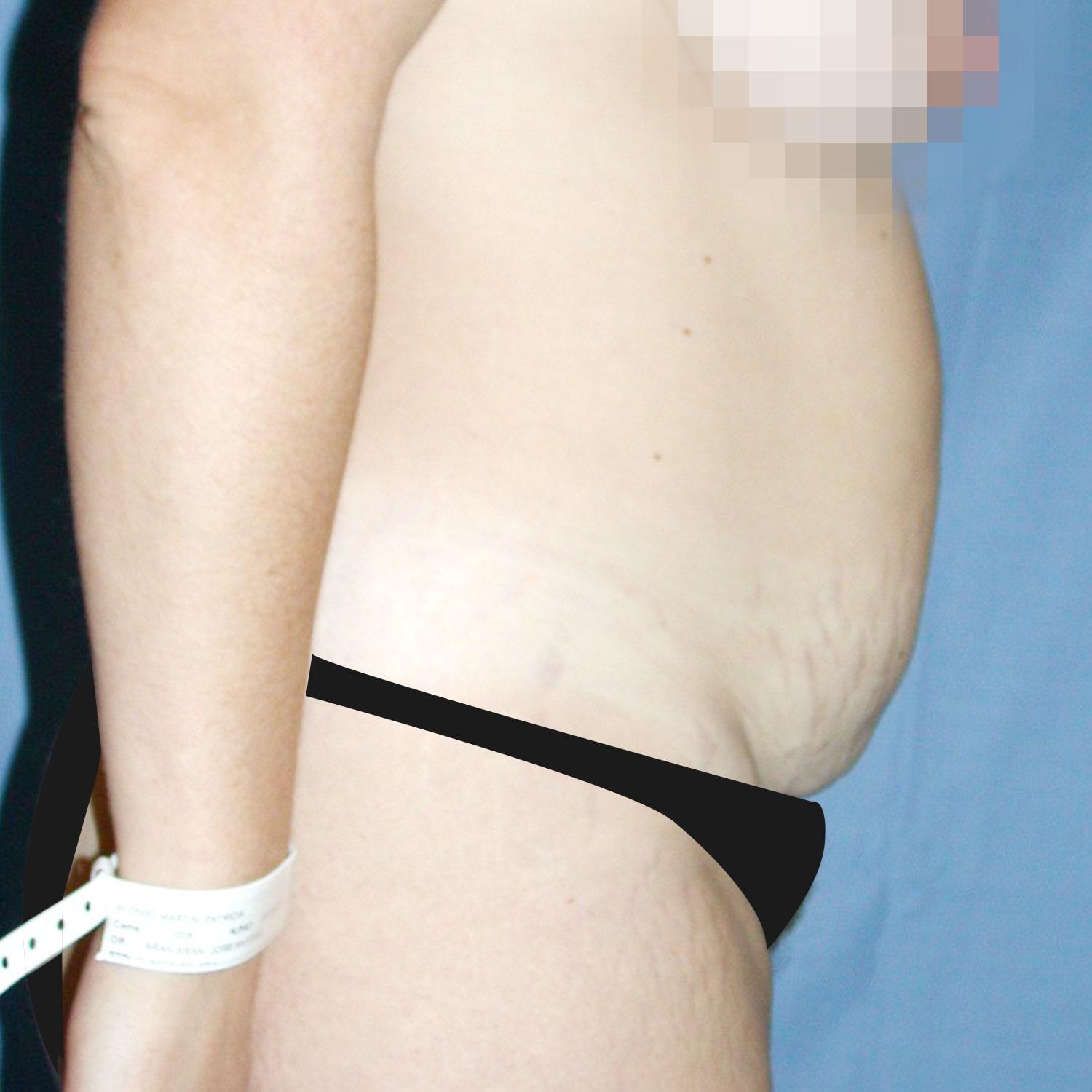 Abdominoplastia