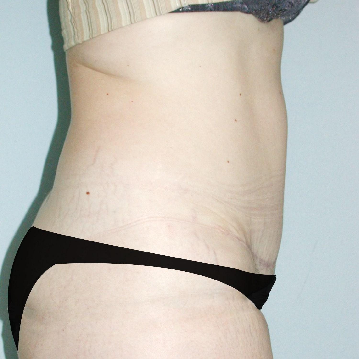 Abdominoplastia