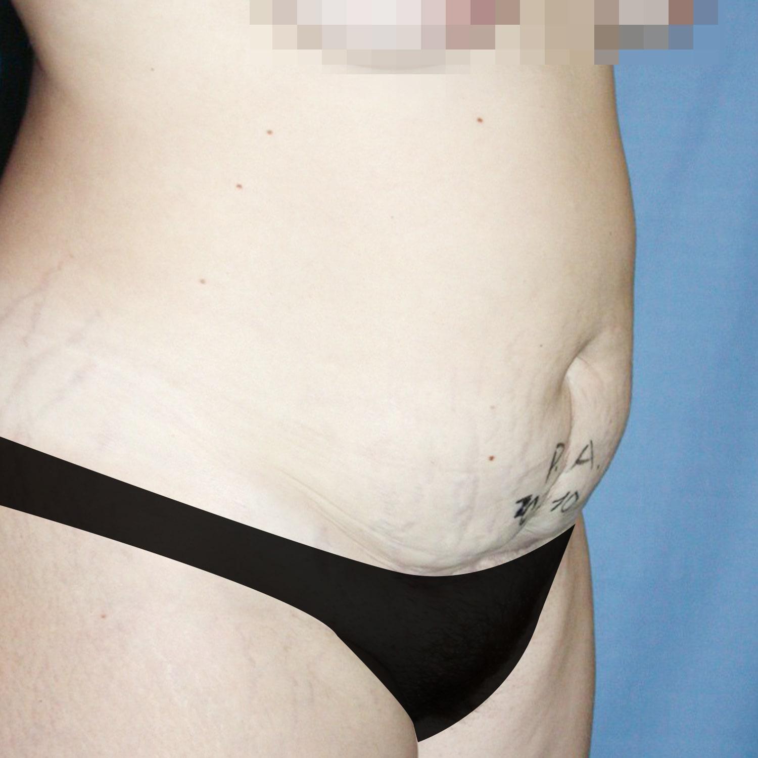 Abdominoplastia