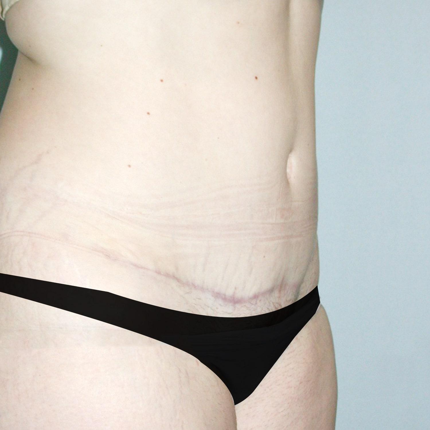 Abdominoplastia