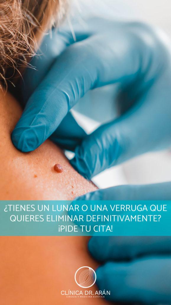 Eliminación de Verrugas