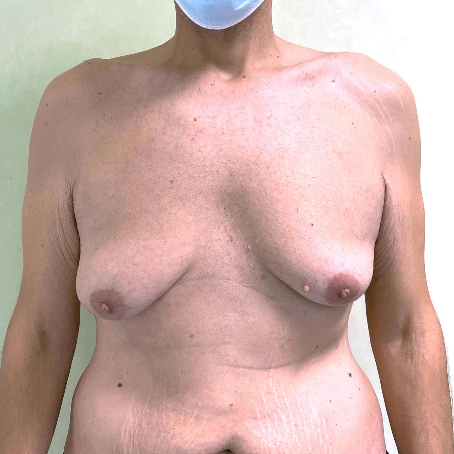 Ginecomastia