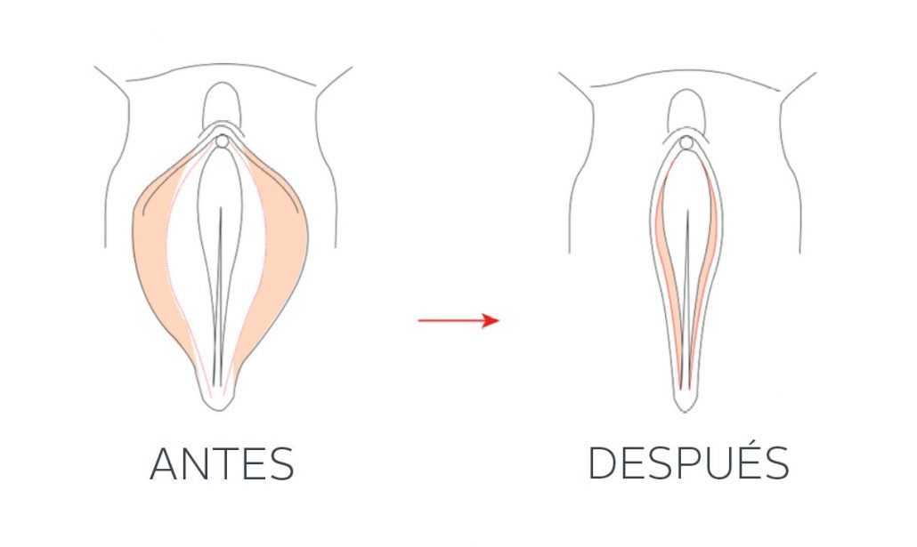labioplastia esquema
