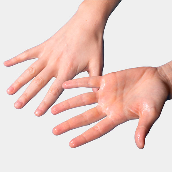 hiperhidrosis palmar