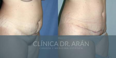 Abdominoplastia