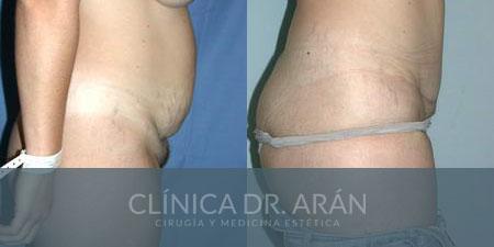 Abdominoplastia