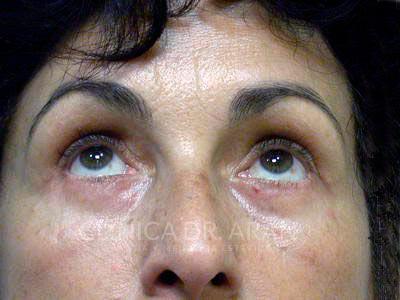 cirugia de parpados
