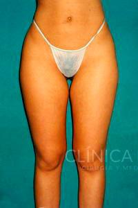 liposuccion muslos
