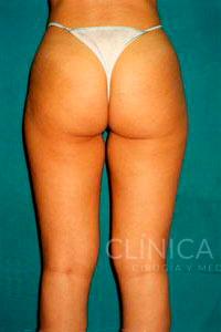 liposuccion muslos