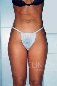 liposuccion muslos