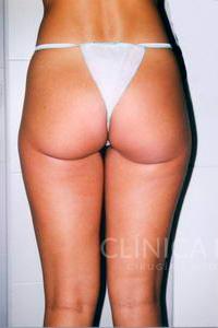 liposuccion muslos