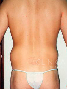 liposuccion en flancos