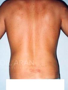 liposuccion en flancos