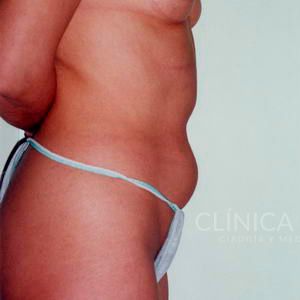 liposuccion en abdomen