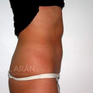 liposuccion en abdomen