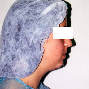 liposuccion cara cuello