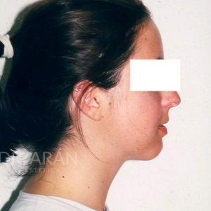 liposuccion cara cuello