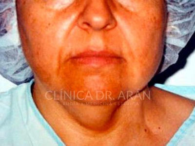 liposuccion cuello papada