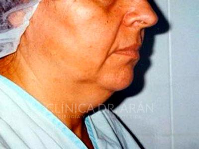 liposuccion cuello papada