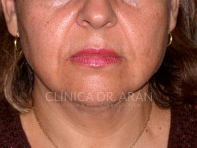 liposuccion cuello papada