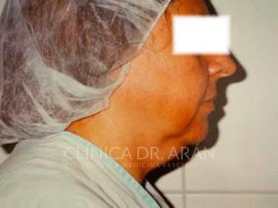liposuccion cuello papada