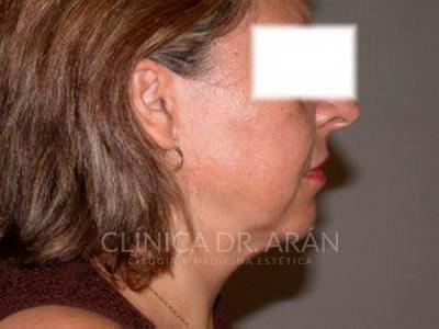 liposuccion cuello papada