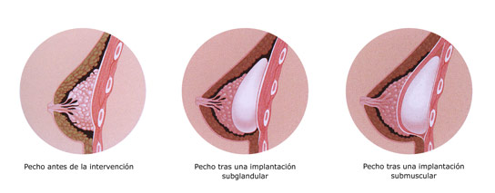 Aumento de mamas