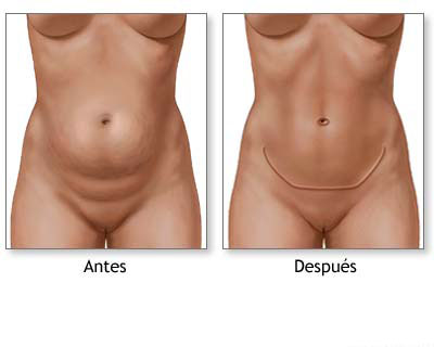 abdominoplastia