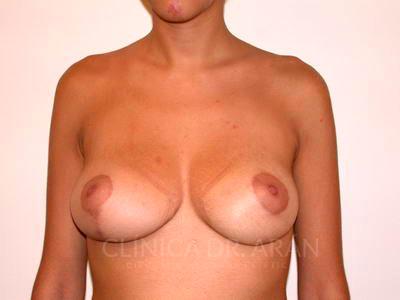 cirugia asimetria mamaria