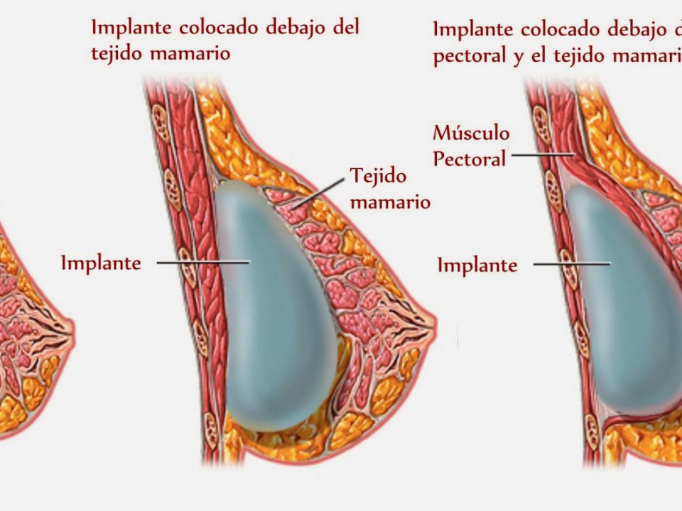 mamoplastia-de-aumento-3