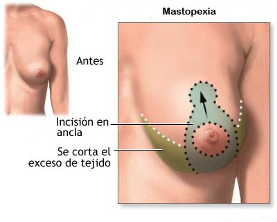 mastopexia-02