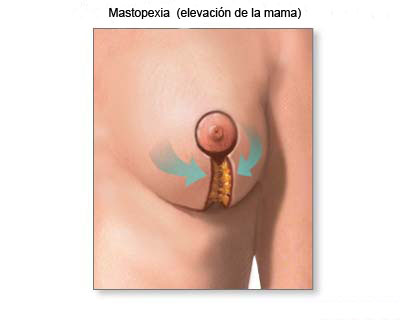 mastopexia-03