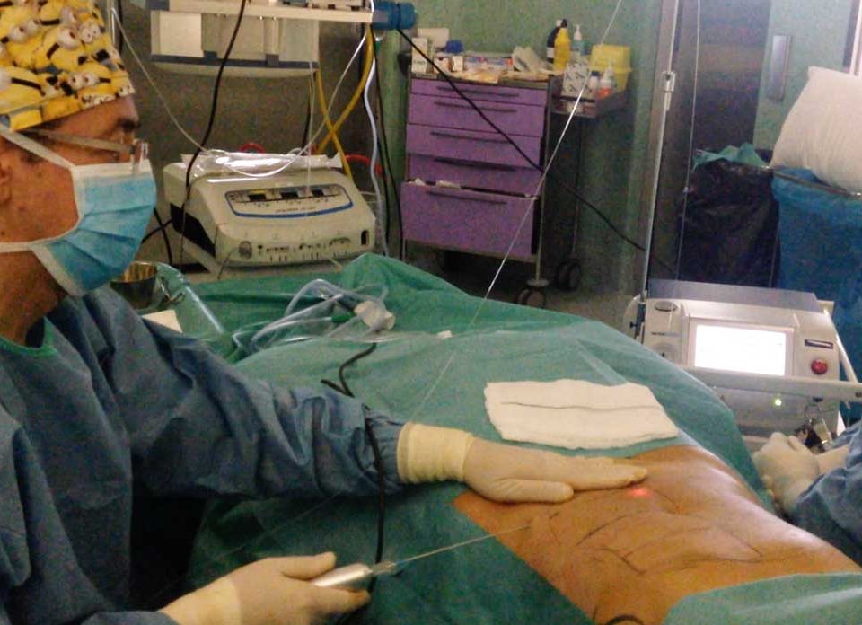 que-es-la-liposuccion-laser