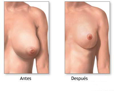 reduccion-mamas